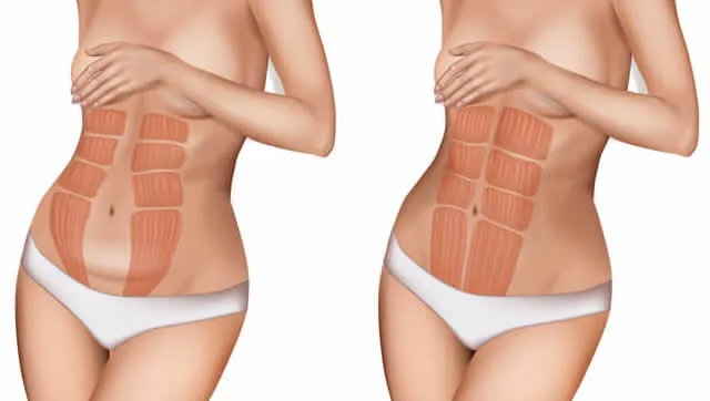 Diástasis abdominal - Fisioterapia Barón, Móstoles