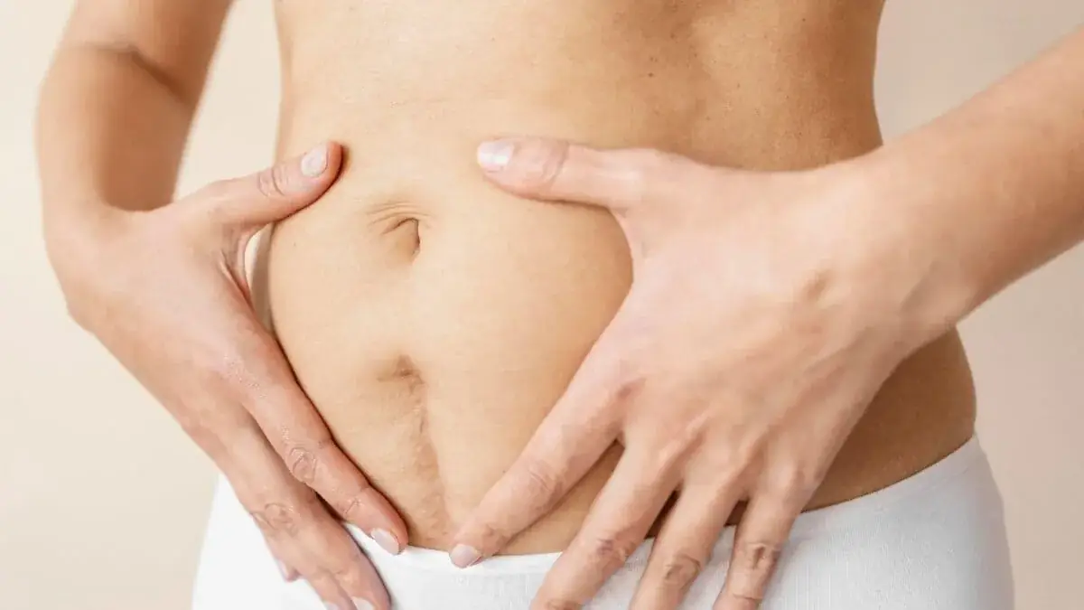 Fisioterapia Dermatofuncional Diástasis y Cicatriz Cesárea, Fisioterapia Barón - Móstoles