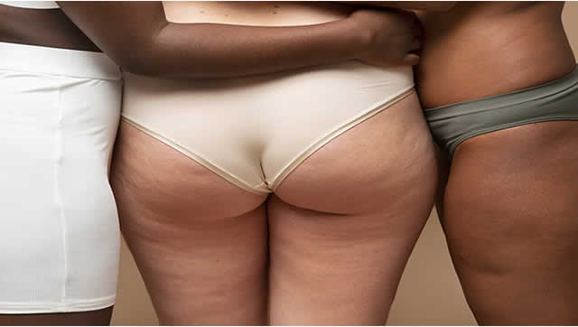 Fisioterapia Lipedema - Fisioterapia Barón, Mostoles