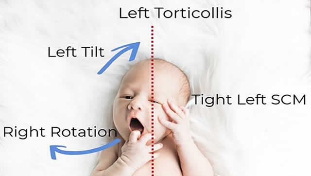Fisioterapia pediatrica Tortícolis congénita, Fisioterapia y Osteopatía Barón, Móstoles